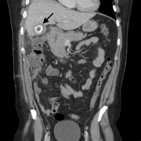 ct scan coronal plane  calcifications   gallbladder