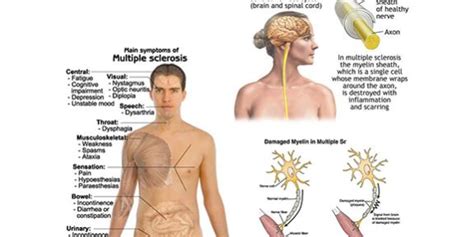 MS Signs & Symptoms – Multiple Sclerosis Society Of Malta