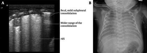 The Role Of Lung Ultrasound In Diagnosis Of Respiratory Distress Syndrome In Newborn Infants