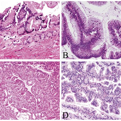 Epithelial Subtypes Of Intraductal Papillary Mucinous Neoplasm A