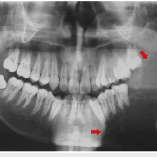 Opg Shows A Well Defined Multilocular Radiolucent Cystic Lesion In The