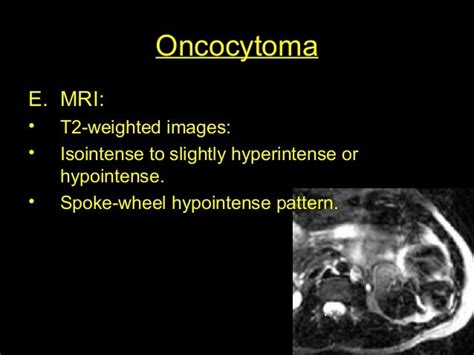 Oncocytoma