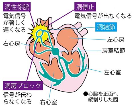 不整脈の種類をセルフ診断｜心房細動や期外収縮の脈拍がわかるグラフつき｜カラダネ