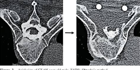 Figure 3 From Surgical Treatment For Ossification Of The Posterior