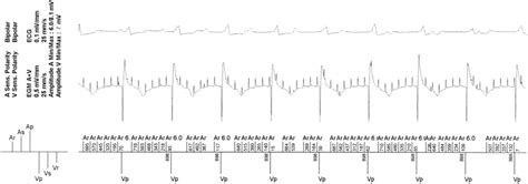 Intracardiac Electrocardiograms Obtained From The Pacemaker Download Scientific Diagram