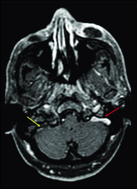 Axial Post Contrast T1w Image Shows Thrombosed Right Sigmoid Sinus And