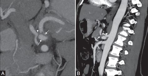 Dissecting celiac artery aneurysm. (A) CT oblique coronal MIP image ...