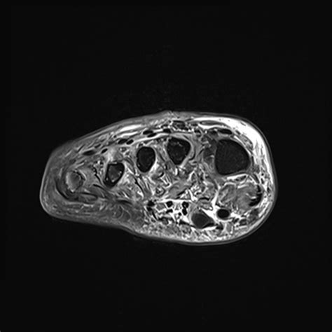 Diabetic Foot Infection Necrotizing Cellulitis And Deep Soft Tissue Infection With