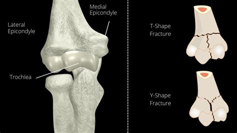 11 Easy Intercondylar Fracture Of Humerus Rehab Exercises