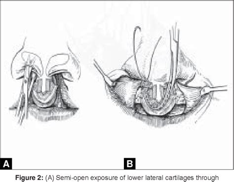 Figure 2 From Repair Of Bilateral Cleft Lip And Its Variants Semantic Scholar