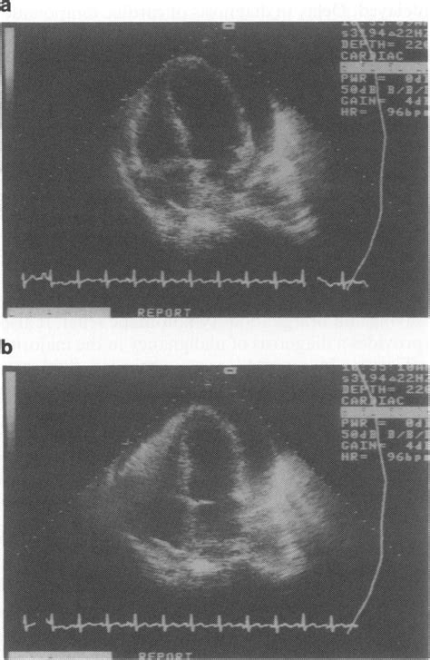 Two Dimensional Trans Thoracic Four Chamber View Echocardiograms In A