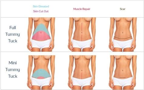 How Much Does A Mini Tummy Tuck Cost Thepricer Media