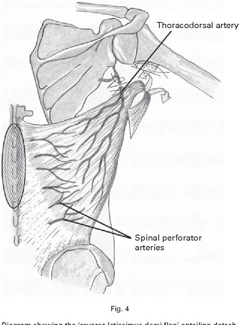 Figure 4 From The Management Of Complex Soft Tissue Defects After