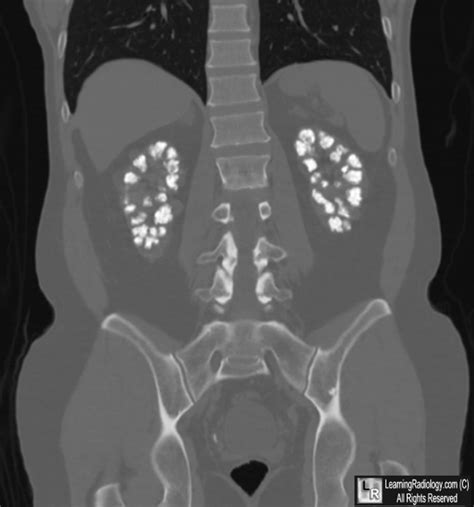 Learningradiology Medullary Nephrocalcinosis