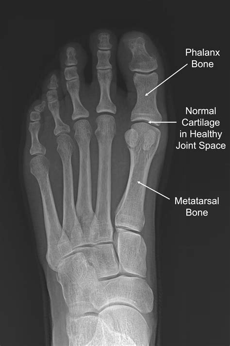 Big Toe Arthritis — Daniel Bohl, MD | Midwest Orthopaedics at RUSH