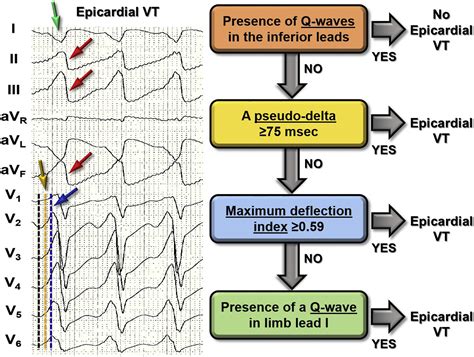 Epicardial Catheter Ablation Of Ventricular Tachycardia Cardiac