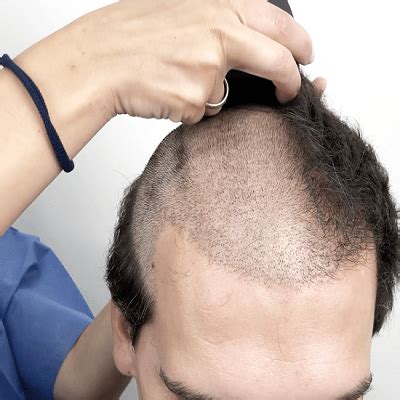 Hair Transplant Restoration Without Shaving Head