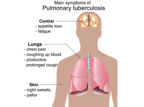 Pulmonary Tuberculosis