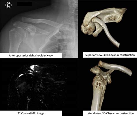 Preoperative Shoulder Images Showing Anteroposterior Right Shoulder