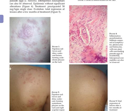 [pdf] Ectopic Cutaneous Schistosomiasis Case Report Semantic Scholar