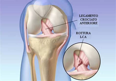 Lesione Legamento Crociato Anteriore Ginocchio Dr Alessio Biazzo