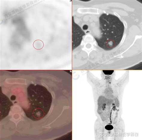 18f Fdg Petct检查“无意中”发现的甲状腺癌4例【高尚医学影像】 知乎