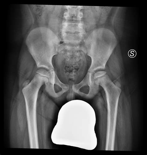 Legg Calvé Perthes Disease Image