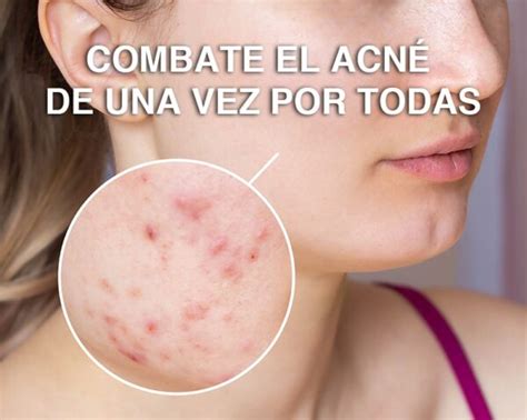 Combate El Acné De Una Vez Por Todas Tips Infalibles De Dermatólogos