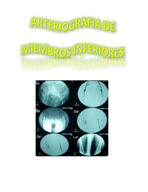 Arteriografia De Miembros Inferiores Angiograf A De Miembros