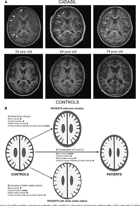 Figure I From White Matter Edema At The Early Stage Of Cerebral Autosomal Dominant Arteriopathy