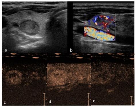 Cancers Free Full Text Performance Of Contrast Enhanced Ultrasound In Thyroid Nodules