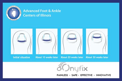 What Is Onyfix Pain Free Nail Correction Kenosha