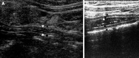 Figure 1 from Transcutaneous cervical esophagus ultrasound in adults ...