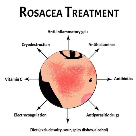 Causes of Rosacea. Rosacea Awareness Month. Infographics. Vector ...