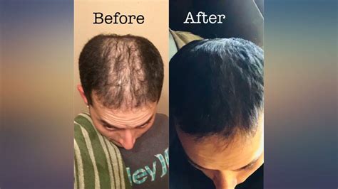 KIRKLAND SIGNATURE Minoxidil for Men 5% Minoxidil Hair Regrowth Treatment 12 Months review - YouTube