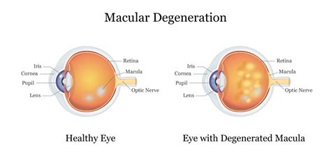 Macular Degeneration and Elmiron | Symptoms of Eye Damage