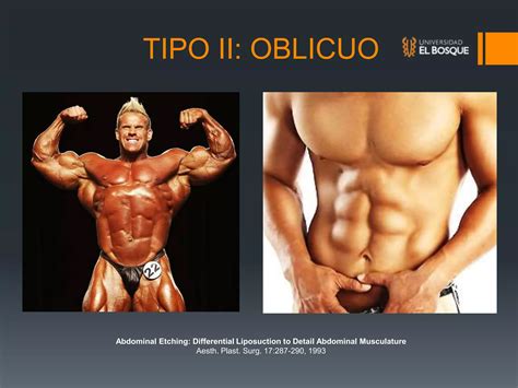 Lipoescultura De Alta Definici N Marcaci N Adbominal Ppt