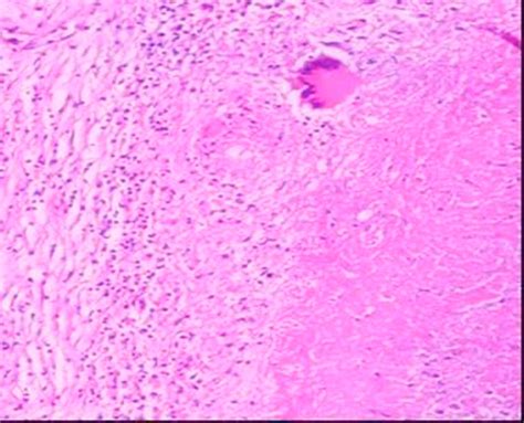 Splenic Granuloma Showing Caseous Necrosis Giant Cells And Lymphocytes