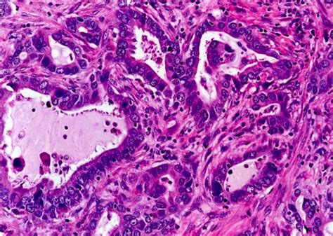 Lung Carcinoma Histology