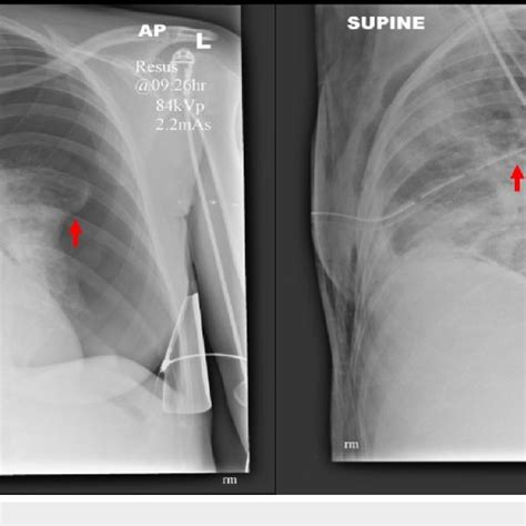 Anteroposterior Chest Radiographs Pre And Postdrain Insertion With Lung