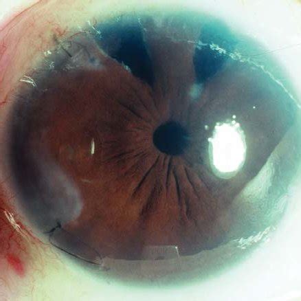 Aphakic right eye with operable bullous keratopathy shown by the ...