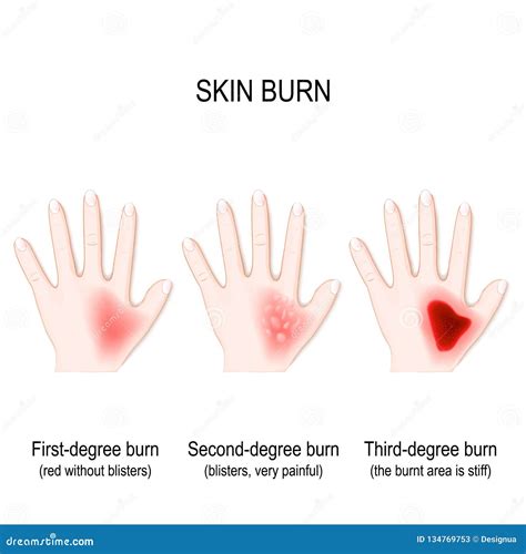 lye burn  lee ramirez blog