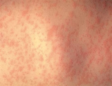 Hiv Skin Rash Images Causes Symptoms Treatment Hubpages