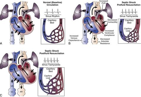 Septic Shock Anesthesia Key