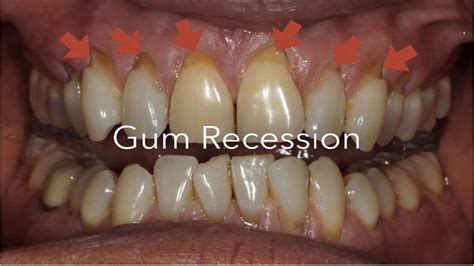 How To Stop Gum Recession Anderson Lake Dental