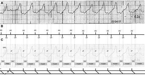 Around And AroundA Wide Complex Tachycardia Circulation