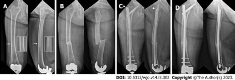 Surgical Strategy Of The Treatment Of Atypical Femoral Fractures