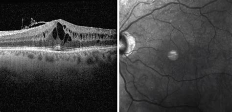 Macular Edema Oct