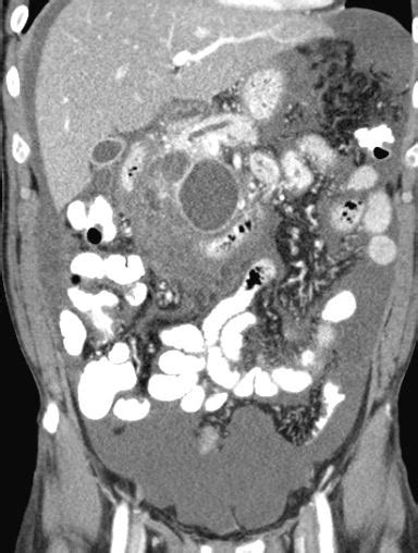 Pancreatic Ascites Image