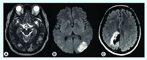 Complications Of Reversible Cerebral Vasoconstriction Syndromes A Download Scientific